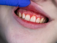 Este nutriente comum do tomate pode ajudar a prevenir doenças gengivais graves