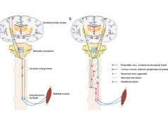 Cientistas são pioneiros no método de fusão para reparo de lesões na medula espinhal