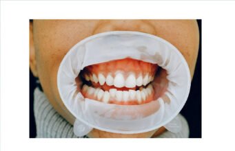 Compreender o papel da saúde periodontal na prevenção da demência