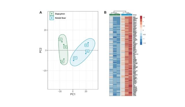 RNA-seq-unravels-distinct-expression-profiles-of-keloids-and-Dupuytren_s-disease.webp.jpeg