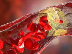 Poderoso medicamento para baixar o colesterol reduz o risco de ataque cardíaco em 31%