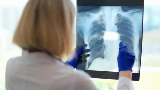 doctor-examines-lung-x-ray.webp.webp