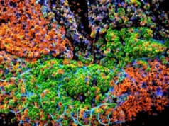 Por que a inflamação intestinal crônica se transforma em câncer de cólon