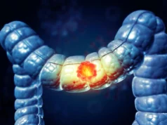 A maioria dos americanos não sabe que este alimento aumenta o risco de câncer de cólon