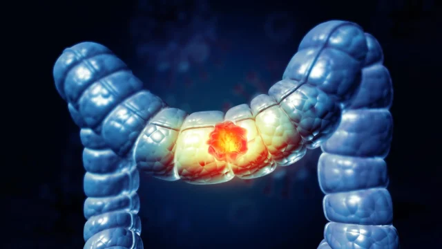 colon-cancer.webp.webp