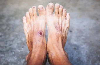 Um estudo global de DNA revela a ameaça oculta das infecções nos pés diabéticos