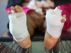 Novo gel de oxigênio pode prevenir amputações em pacientes diabéticos com feridas