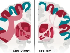 Cientistas podem ter descoberto rede cerebral por trás da doença de Parkinson