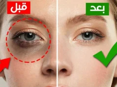 O que causa as olheiras?..A melhor maneira de se livrar das olheiras