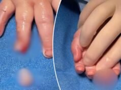 Foi alegado que o dedo do bebê foi cortado no berçário