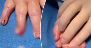 Foi alegado que o dedo do bebê foi cortado no berçário