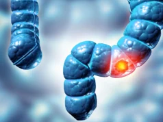 Dois tipos de pólipos de cólon podem aumentar em cinco vezes o risco de câncer de intestino, segundo estudo