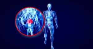 Cientistas de Stanford dizem que daltonismo pode esconder alerta mortal sobre câncer de bexiga