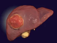 Estudo descobre que comer menos proteína pode retardar o crescimento do câncer de fígado