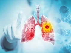Cientistas descobrem por que essa forma mortal de câncer de pulmão continua voltando