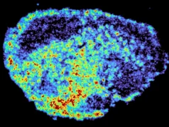 Cientistas descobrem por que medicamentos contra o câncer não funcionam para todos