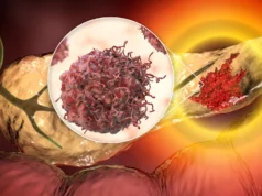 Novo exame de sangue pode detectar câncer de pâncreas antes que seja tarde demais