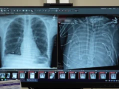 Ele sobreviveu sem pulmões por 48 horas