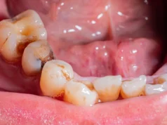 Reparar infecções dentárias pode melhorar o açúcar no sangue e a saúde do coração