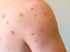 O primeiro caso da forma mais agressiva e contagiosa de “varíola dos macacos” foi relatado na Argentina