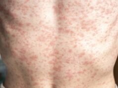 Compradores de Portland evitam locais de exposição em meio a surto de sarampo