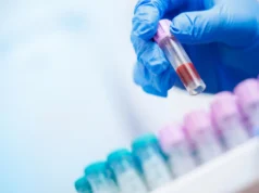 Um simples exame de sangue pode revelar o risco de Alzheimer com anos de antecedência