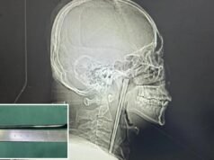 Bêbado chinês passou 8 anos com uma haste de metal presa na garganta antes que os médicos a removessem