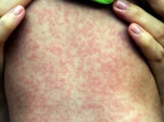 Centro de saúde da cidade de Oregon vê exposição ao sarampo, alerta Autoridade de Saúde de Oregon