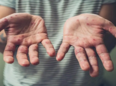 Mortes infantis aumentam em Bangladesh devido ao aumento de casos de sarampo e preocupações com vacinas