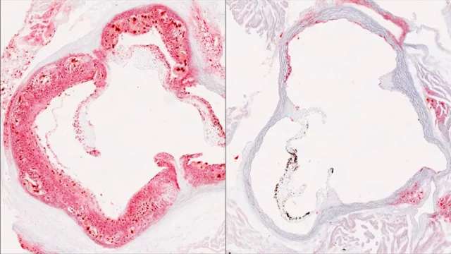 cholesterol-ldlr-helz2-atherosclerotic-plaque.webp.webp