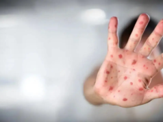 O número de mortes devido ao sarampo em Bangladesh aumentou para 280 à medida que a epidemia se intensificou