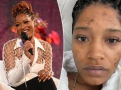 A condição de Keke Palmer deu-lhe pele de ‘vidro rachado’ e correção de TMI